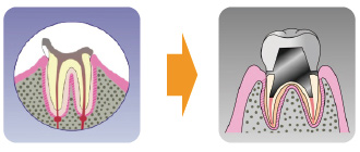 歯冠が無くなる（根は残っている）