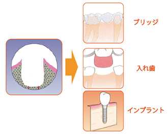 歯の根ごと無くなる（抜けている）