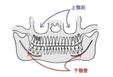 親知らずの抜歯方法