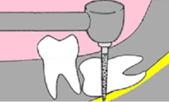 親知らずの抜歯方法